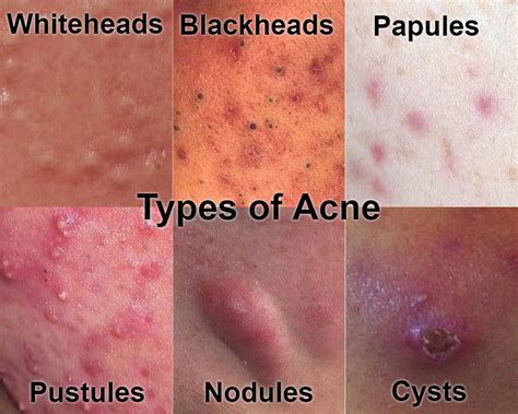 acne types pimples get rid face severe treat forms skin body treatment remedies different pimple papules vulgaris mild spots nodules