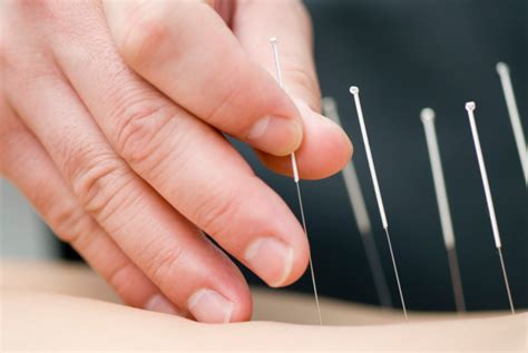 acupuncture needles