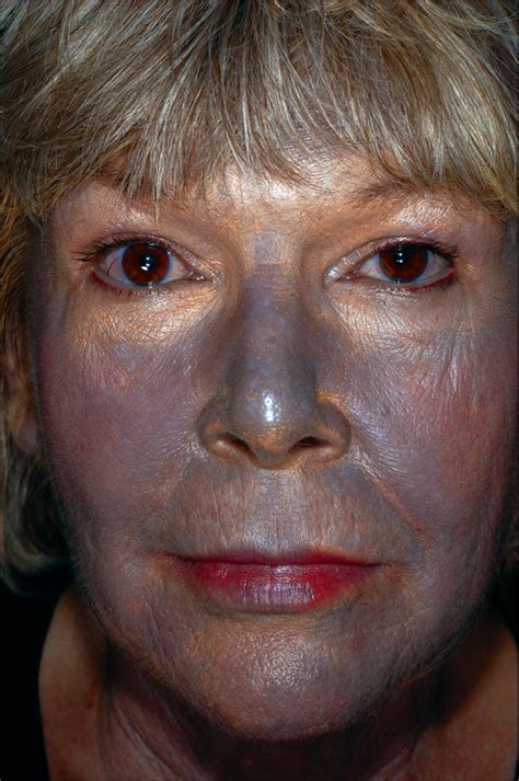 argyria treatment laser