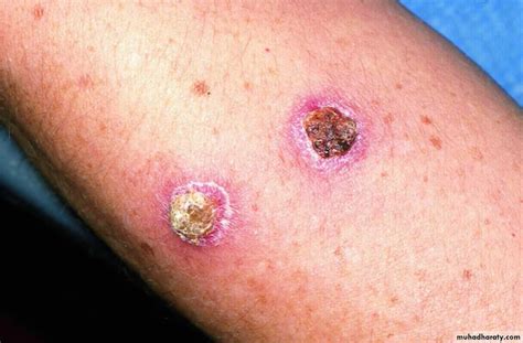 skin infection bacterial pptx impetigo streptococcus due complications syndrome scalded