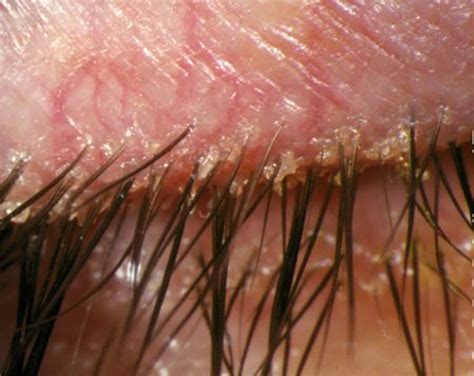 blepharitis eyelid eyelids eyes eyelashes eye crusty symptoms crusting angular treatment swollen red causes