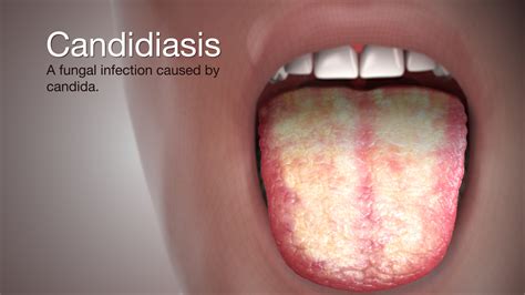 candidiasis causes yeast types symptoms candida infection treatment skin mouth throat fungus type fi gut case fungal