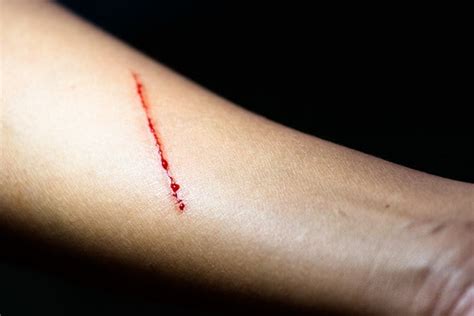 mupirocin vs cuts scrapes wound treating bacitracin ointment neosporin bactroban infection skin wounds ointments comparison healing which