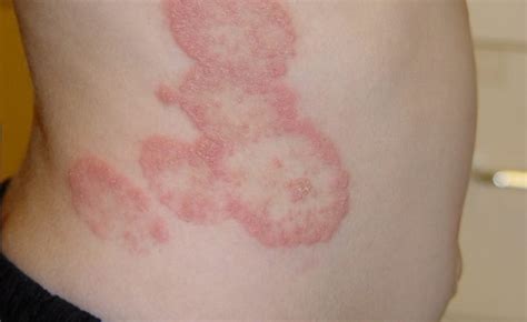 fungal infections infection skin treat treatment disease painful caused antifungal over ringworm