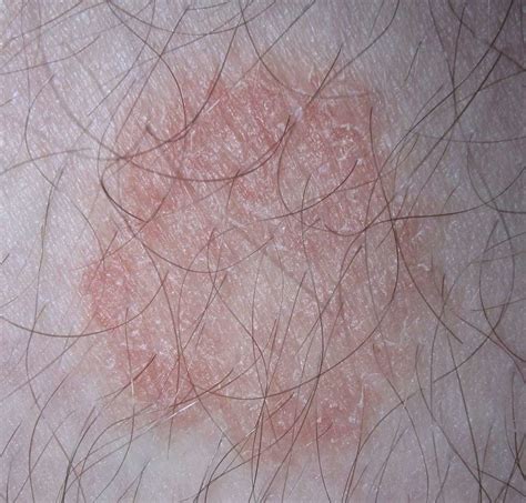 fungal infection tinea corporis versicolor unguium