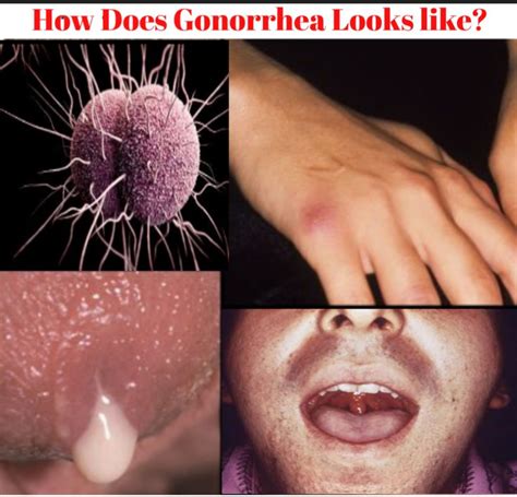 gonorrhea untreated
