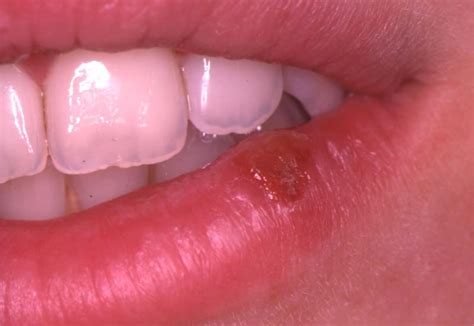 herpes simplex virus mouth hsv lesions sore oral figure