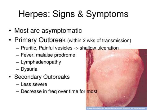 herpes std stds outbreak prodrome painful