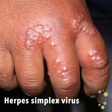 herpes simplex virus hand vesicles dorsal crops monomorphic