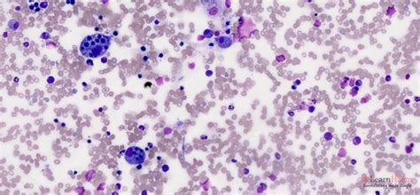 histoplasmosis histoplasma