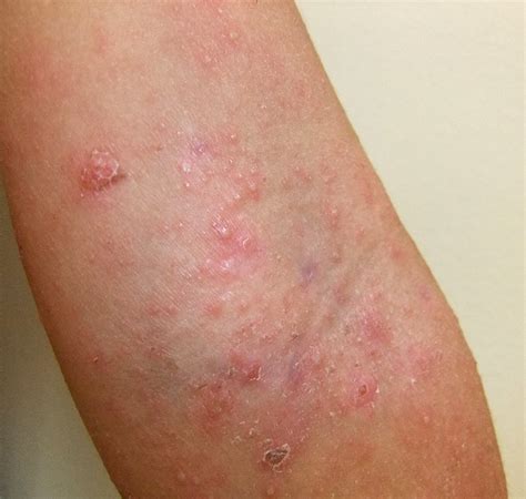 impetigo rashes child preschool daycare