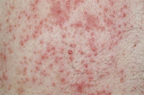 dermatitis nhs symptoms