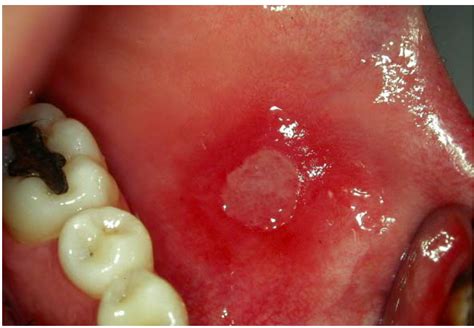 oral lesions mucous inflammatory benign membranes conditions