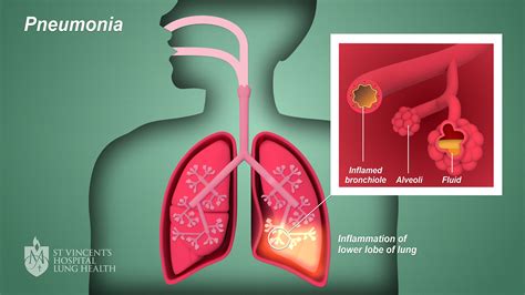 pneumonia lung causes health vincent st