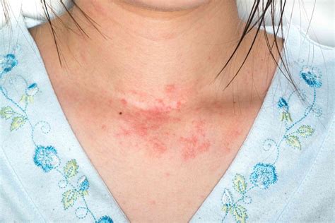rashes eczema allergic allergy dermatitis
