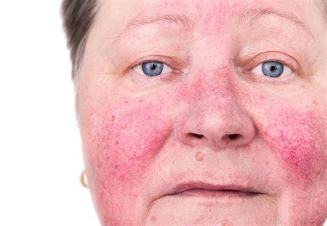rosacea face symptoms redness treatment causes look different