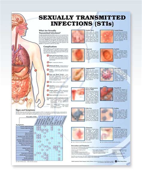 transmitted sexually infections poster sti clinicalposters chart education stis anatomy