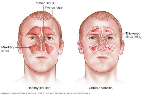 sinusitis acute symptoms blocked disease cold signs