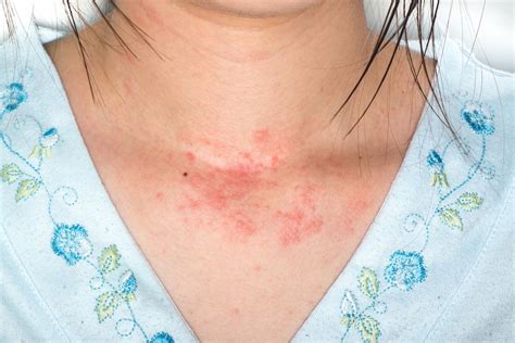 skin allergy allergic rashes