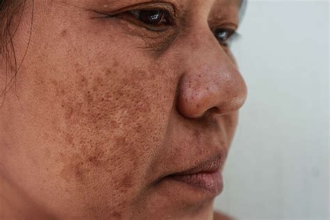 discoloration melasma