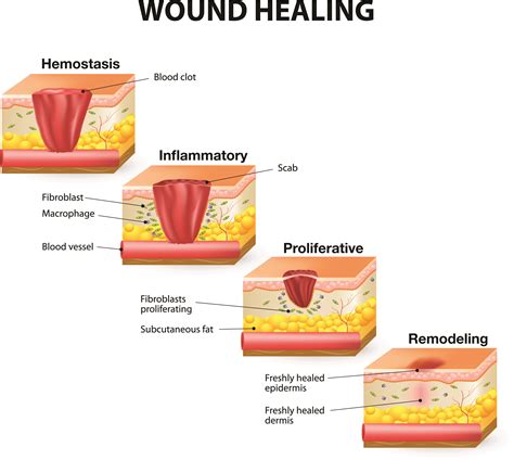 healing wound phases wounds heal stages hemostasis main