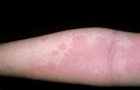 rash rashes urticaria hives