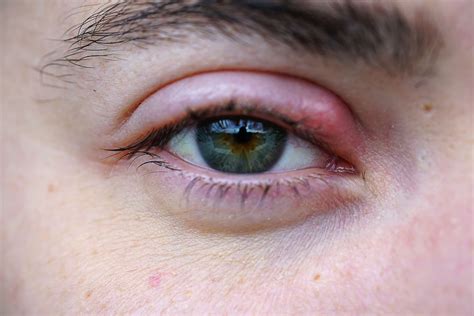 stye symptoms complications istock