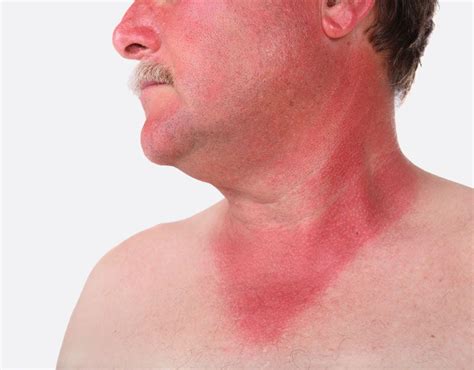 sunburn skin burn symptoms light
