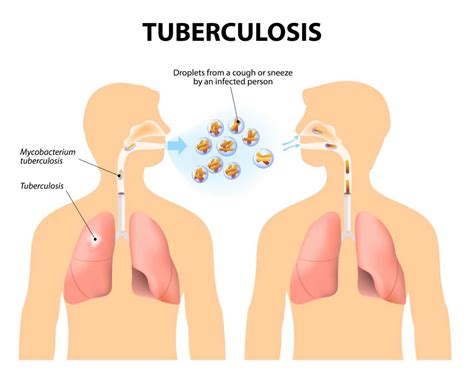 tb tuberculosis causes symptoms family know safe keep do