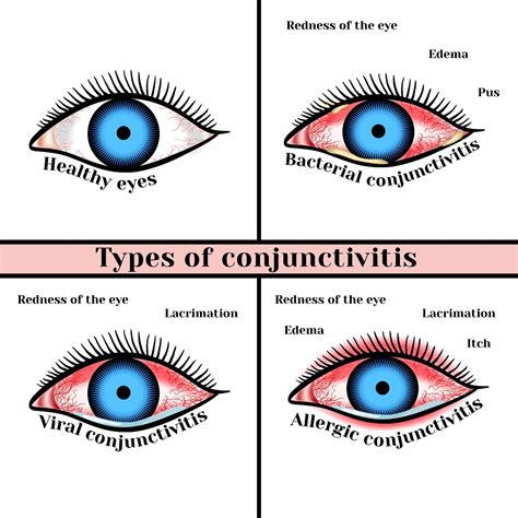 eye conjunctivitis viral treatment infection types pink infections symptoms std eyes herpes causes discharge bacteria ocular which virus cause conjuctivitis