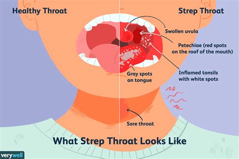 strep sore streptococcus swollen verywellhealth streptocoque gorge pyogenes sores uvula diagnosis verywell