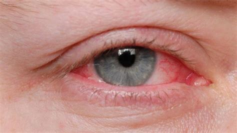 antibiotic eyedrops symptoms