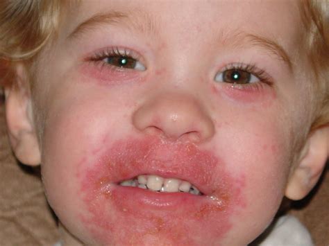 rash antibiotic dermatitis perioral pediatric diseaeseshows