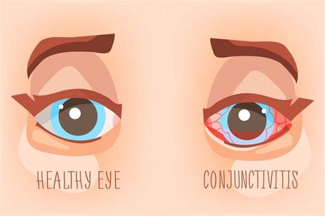 infection conjunctivitis eyecare conjonctivite yeux malades oeil bloodshot