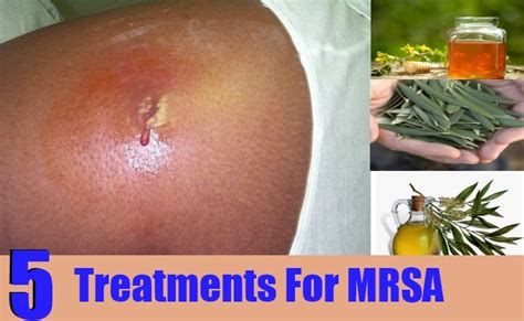 mrsa treatment effective treatments remedies natural oil coconut neem cider vinegar garlic tea apple tree homeremedies