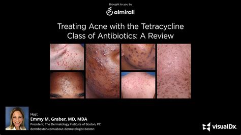 tetracycline acne antibiotics